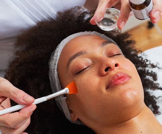Chemical Peels