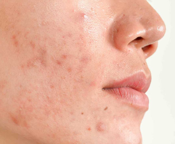 Pimples/Acne