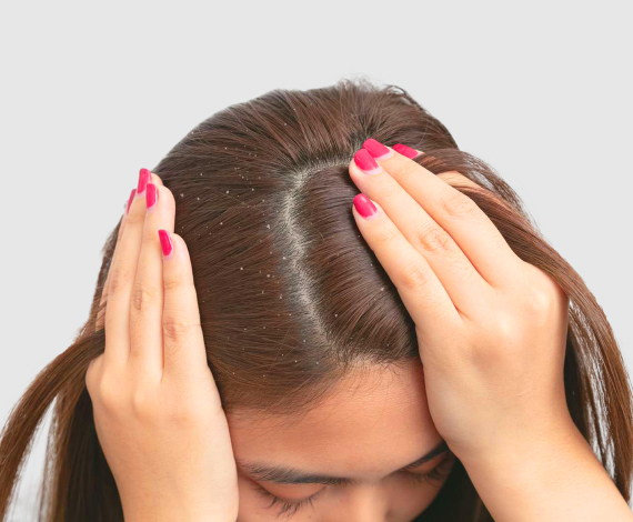 Symptoms of dandruff