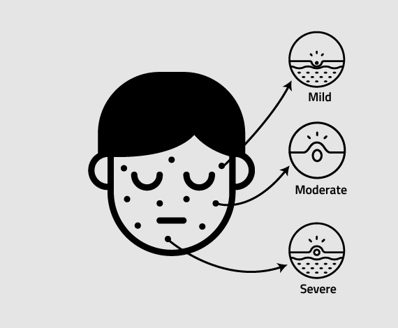 Types of acne