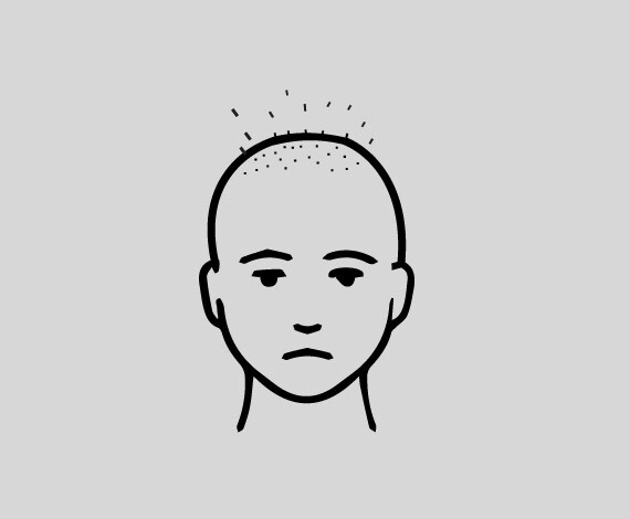 After 3 weeks your existing hair will fall off