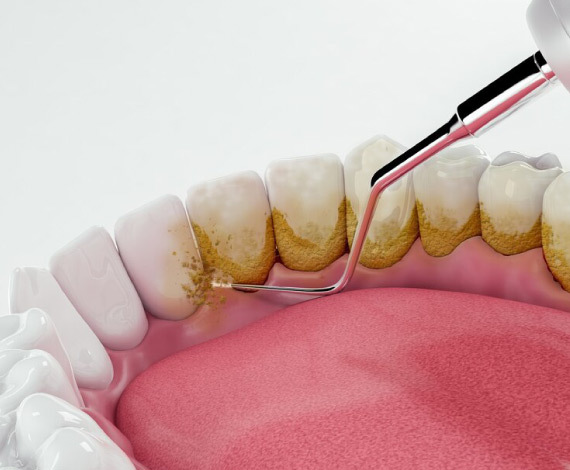 Why do you need to do tooth scaling & polishing?