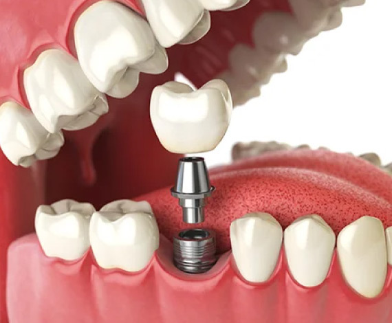 What is Dental Implants?