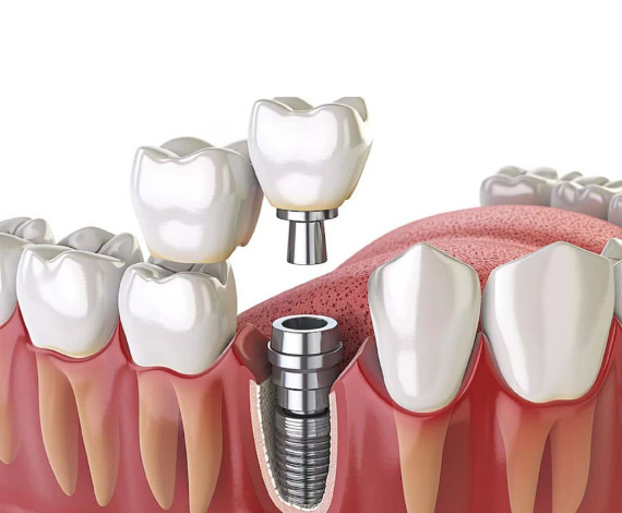 How should you take care of your dental implant?