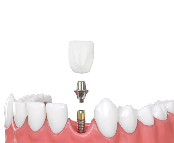 Types of dental implants