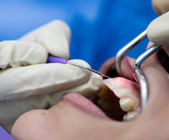 Gummy Smile Correction Procedures