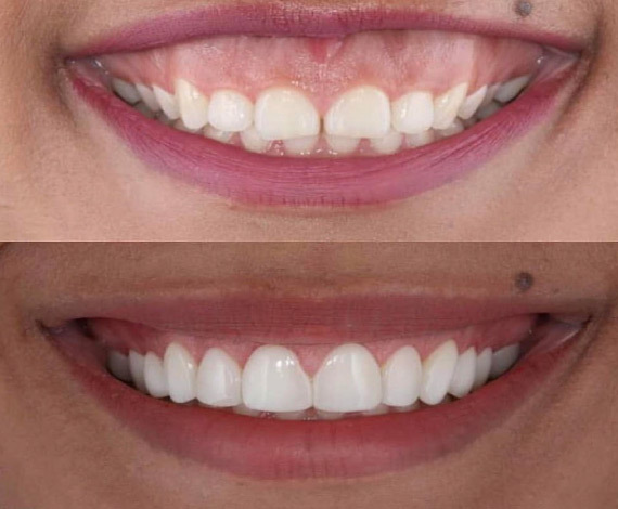 What is gummy smile correction?