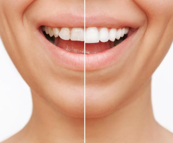 Advantages of Dental Veneers: