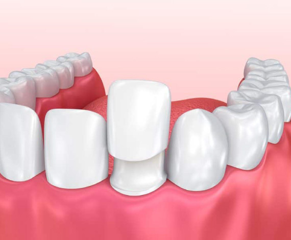 How long do veneers last on your teeth?