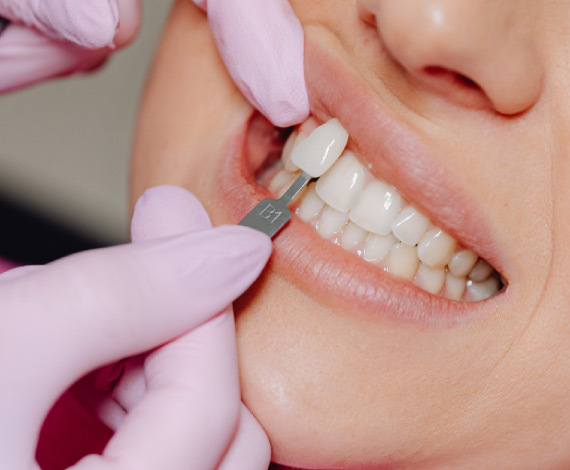 The Dental Veneer Procedure