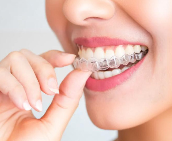 What is Clear Aligners?