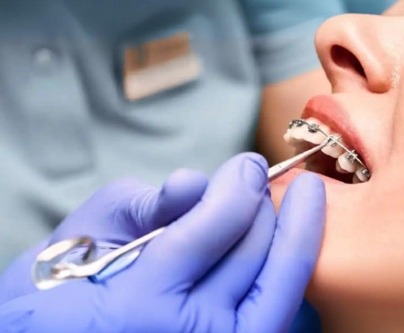 What are types of Orthodontic Treatment?