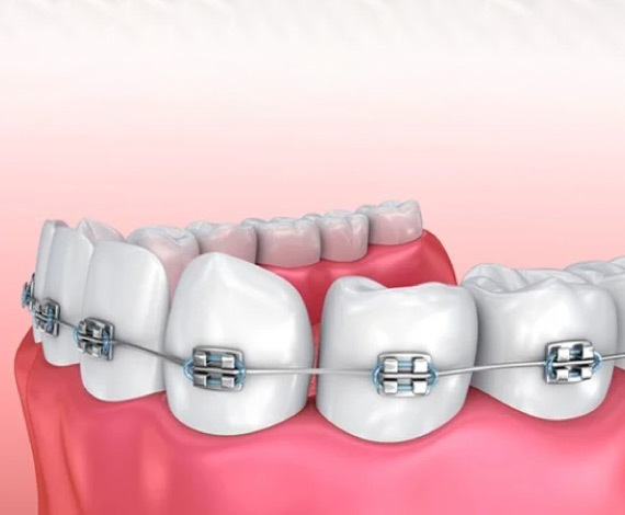 What is Orthodontic Treatment?