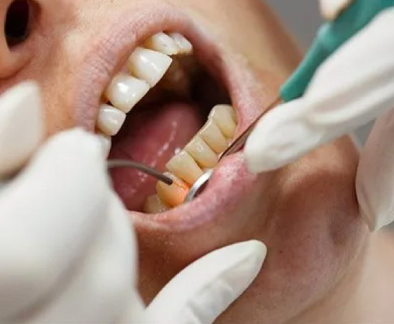 The Gum Depigmentation Procedure
