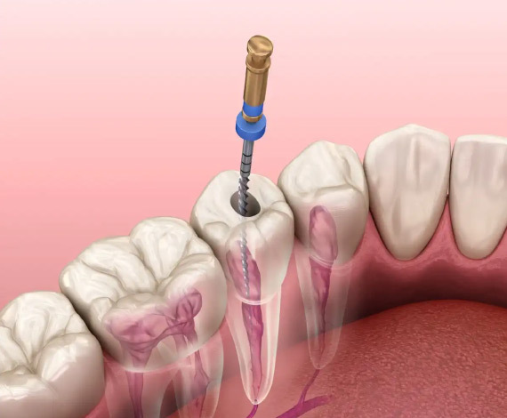 What is Root Canal?