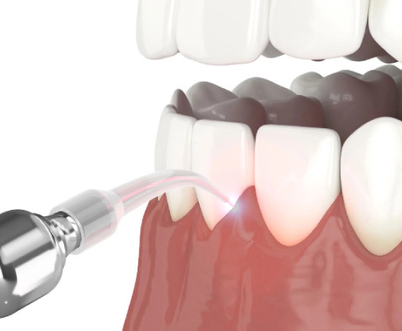 What is Gum Depigmentation?