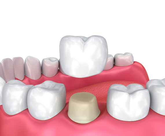 What are Crowns and Bridges?