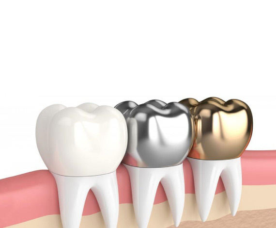 How can you take care of your dental crowns