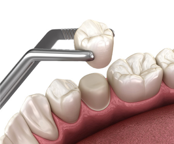 When are the dental crowns used?