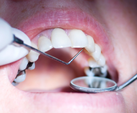 How can we prevent tooth decay?