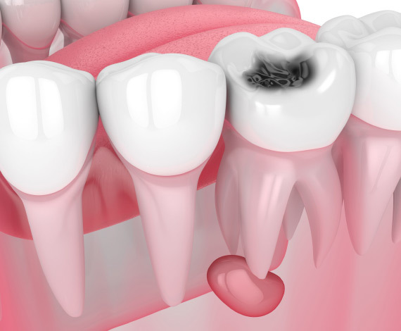 What is Tooth Decay & Cavity Treatment?