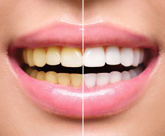 What is Teeth whitening?