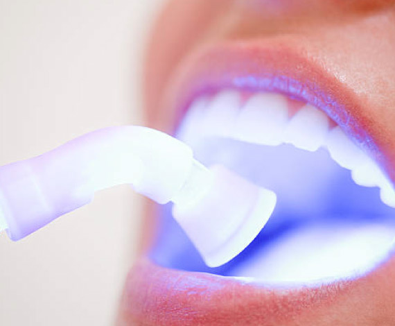 What is the procedure for teeth whitening treatments?