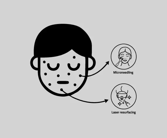 Treatments for Acne scars