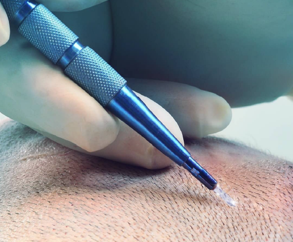 Sapphire Hair Transplant