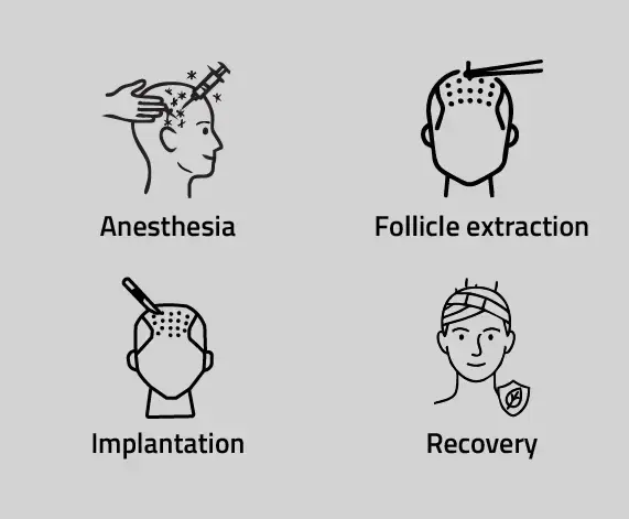 Pen Method Hair Transplant Procedure